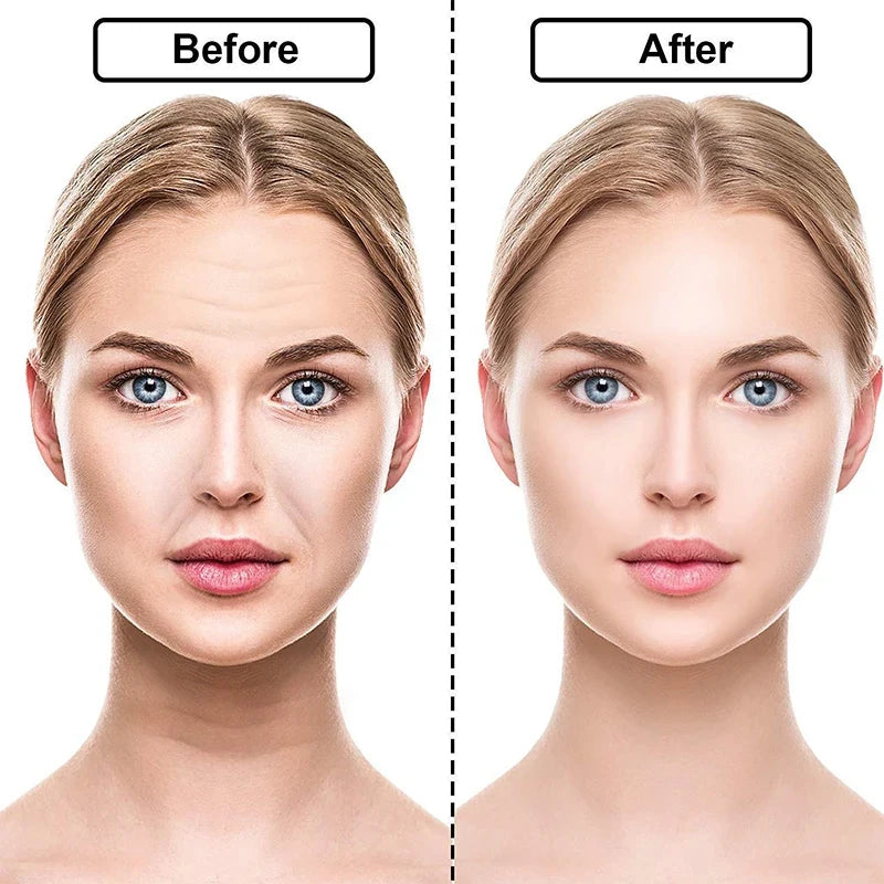 Kit Rejuvene Clean - Adesivos Anti-Rugas das famosas (Reutilizável)